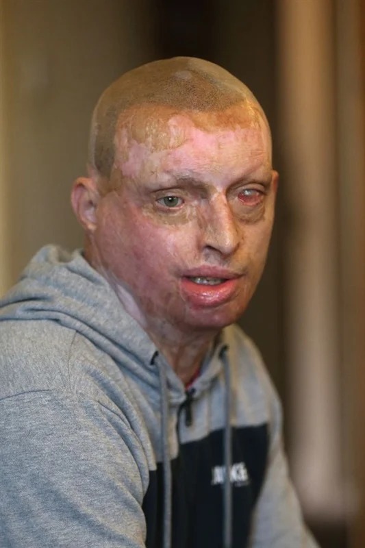 دمرت حياته.. امرأة تسكب مادة حارقة على وجه زوجها أثناء نومه - المواطن