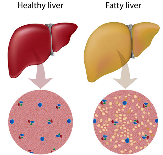 ما هي أعراض تليف الكبد وما أهميته؟