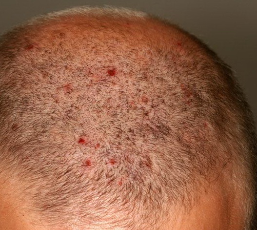 طرق علاج فطريات الرأس
