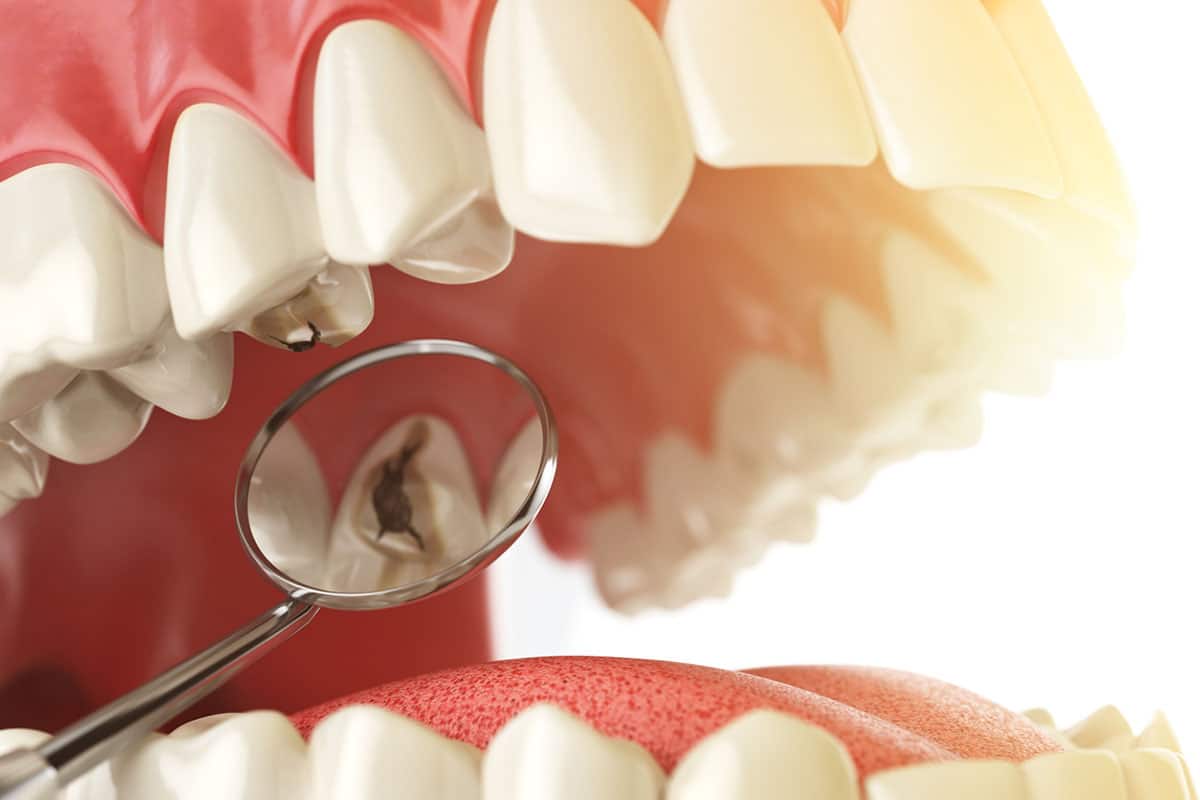 كيفية علاج التهاب عصب الأسنان 