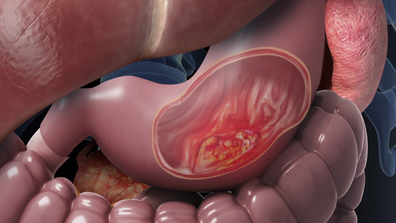 أعراض شلل المعدة الناتج عن ارتفاع السكر في الدم