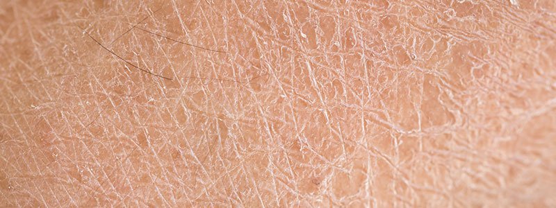 الجلد الجاف قد يكون علامة على مرض مزمن