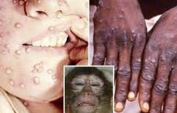 جدري القرود وباء جديد يهدد البشرية