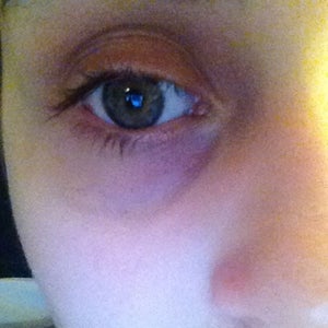 احذر زرقة الجلد تحت العينين قد تكون مؤشرًا لهذه الأمراض  (3)