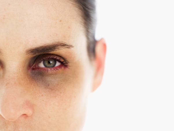 احذر زرقة الجلد تحت العينين قد تكون مؤشرًا لهذه الأمراض  (3)