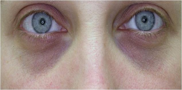 احذر زرقة الجلد تحت العينين قد تكون مؤشرًا لهذه الأمراض 