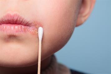 يصيب الفم والجهاز التناسلي.. معلومات قد لا تعرفها عن الهربس البسيط