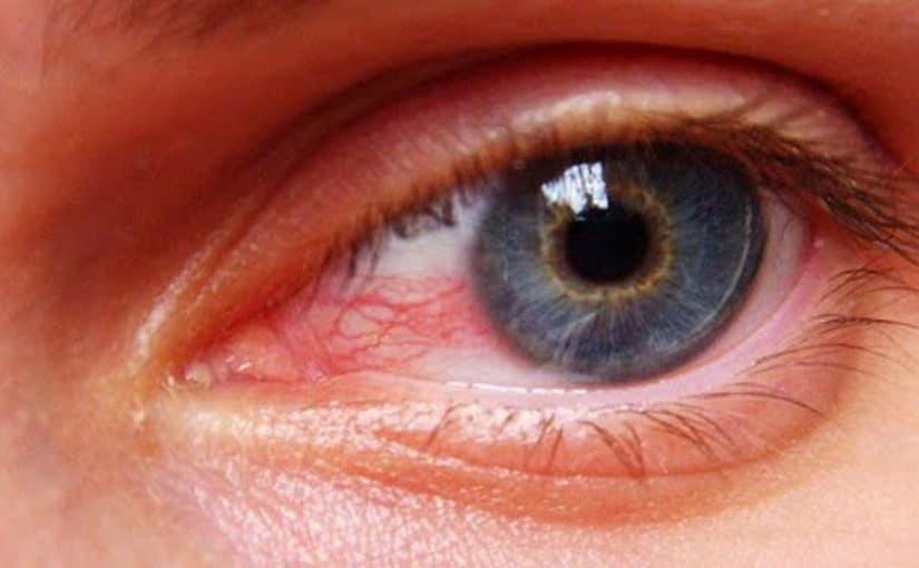 أسباب احمرار العين وعلاجها 