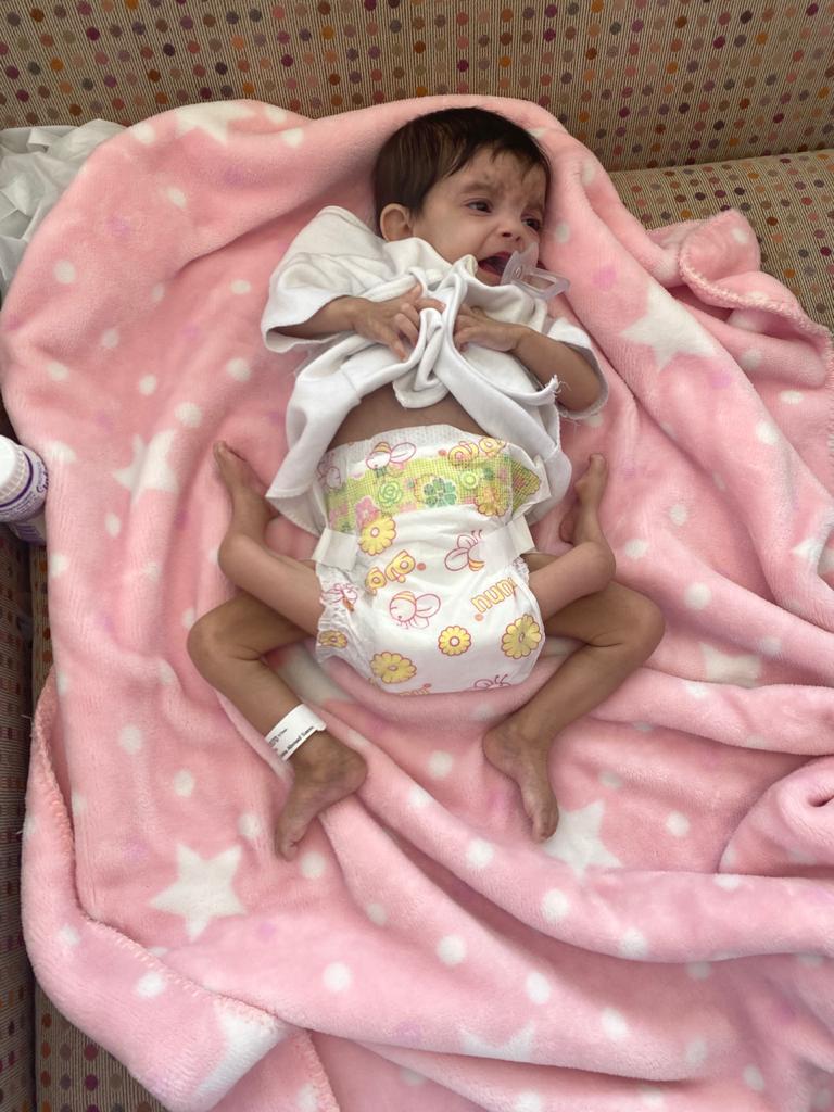 بدء إجراءات فحص فصل التوأم الطفيلي اليمني في الرياض