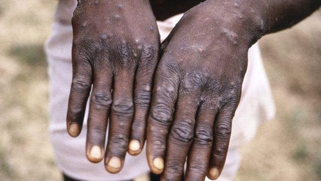 أعراض وطرق الوقاية من جدري القرود