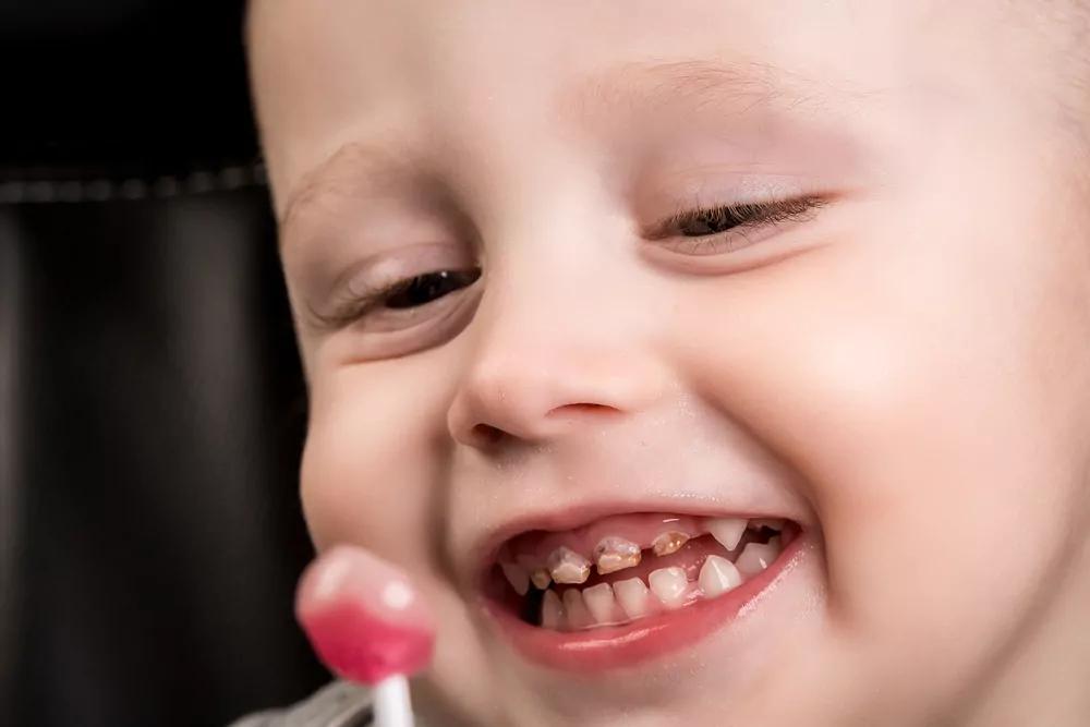 93 % من أطفال المدارس يعانون تسوس الأسنان في السعودية