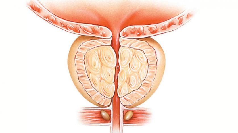 3 معلومات مهمة عن تضخم البروستاتا الحميد