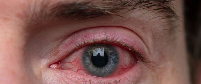 5 أسباب شائعة لاحمرار العين