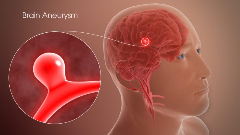 ما هو تمدد الأوعية الدموية في الدماغ الذي أصاب الرئيس الصيني ؟