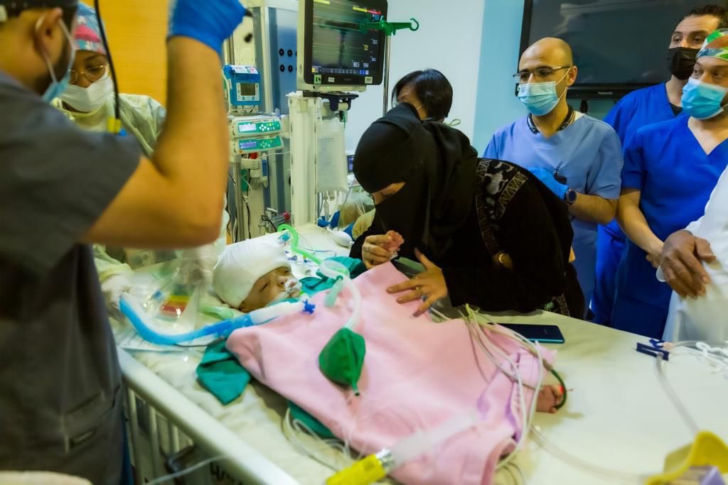 نجاح فصل التوأم السيامي اليمني يوسف وياسين بعد عملية 15 ساعة