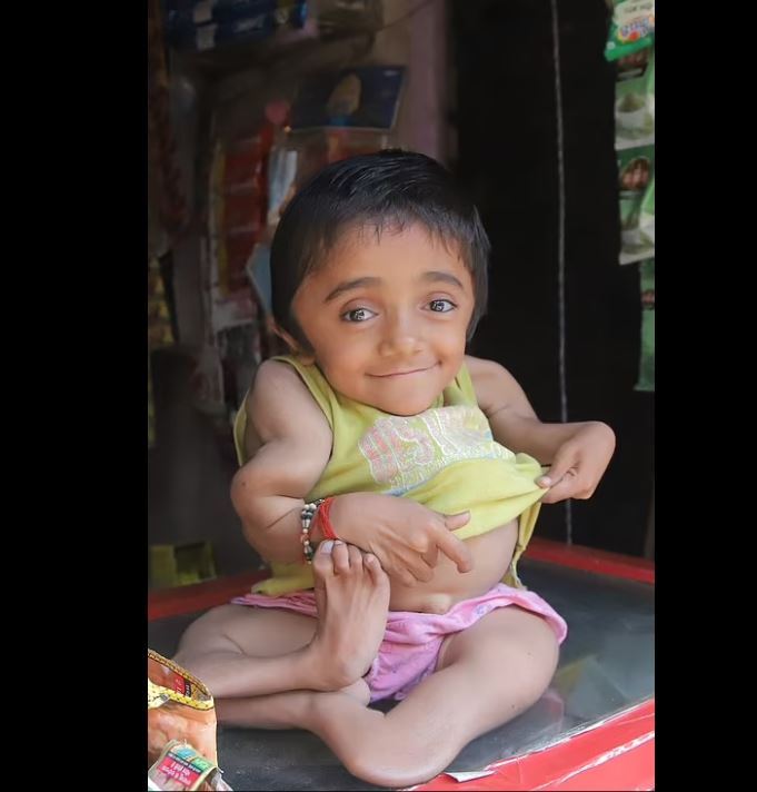 طفل هندي يعاني من هشاشة عظام شديدة