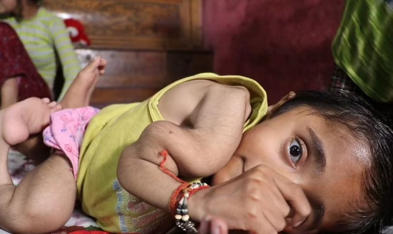 طفل هندي يعاني من هشاشة عظام شديدة