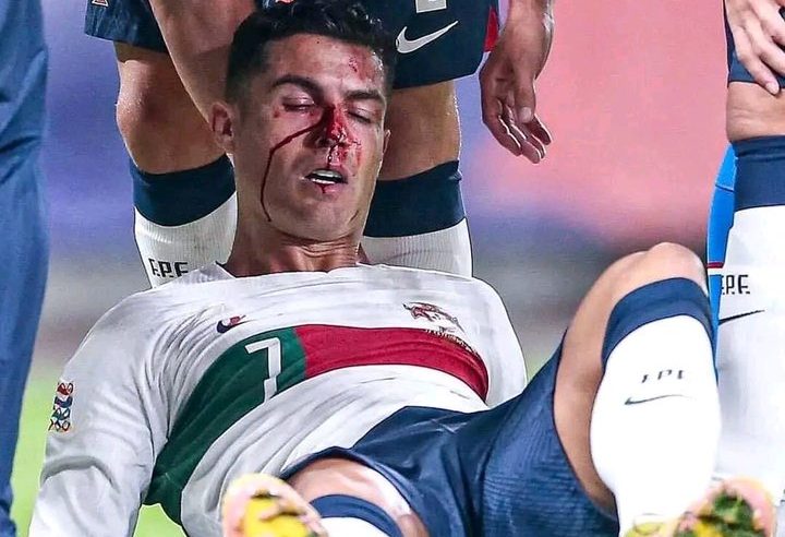 رونالدو يتعرض لإصابة دامية في وجهه