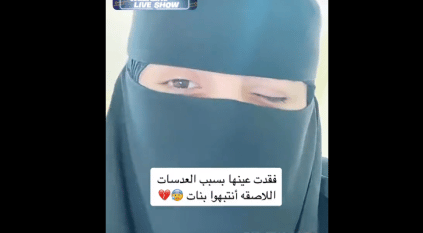 فتاة تحذر: فقدت عيني بسبب نومي بـ العدسات