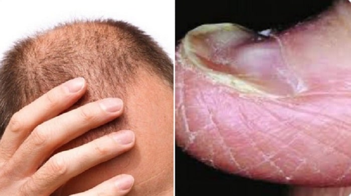 فقر الدم قد يؤدي لتساقط الشعر وتغير الأظافر