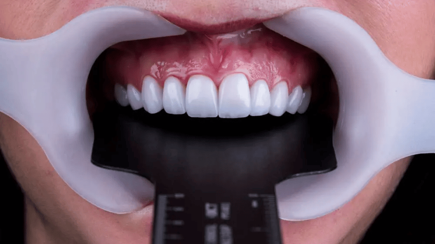 عمليات الأسنان التجميلية قد تسبب الضغط والسكري