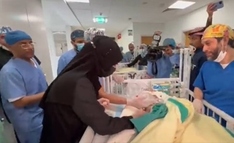 لحظات مؤثرة لوالدة التوأم السيامي العراقي بعد انفصالهما