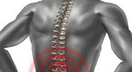 3 طرق لعلاج انحراف العمود الفقري