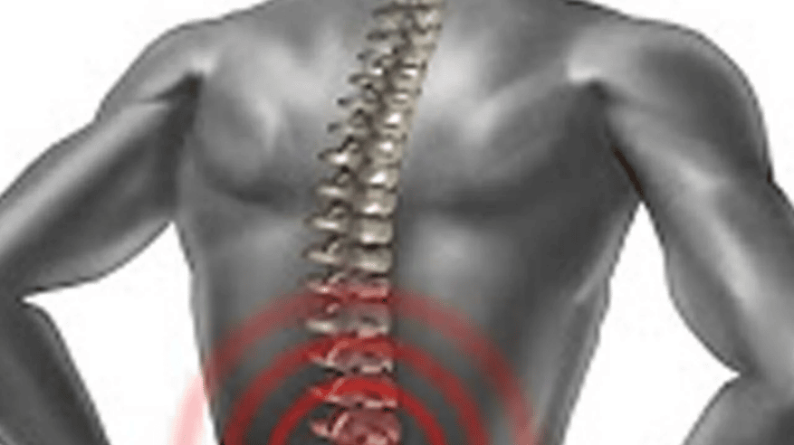 أبرز طرق علاج آلام فقرات الظهر