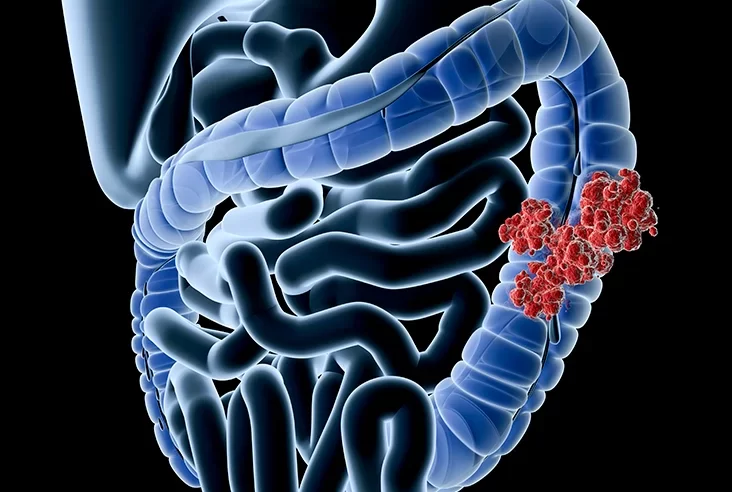 العلاقة بين زيادة الوزن وسرطان القولون