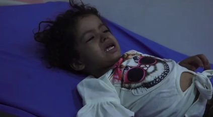 تحذيرات من تحول الحصبة إلى وباء بين أطفال اليمن