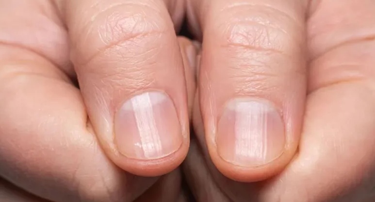 اختبار بالأصابع يكشف إصابتك بسرطان الرئة