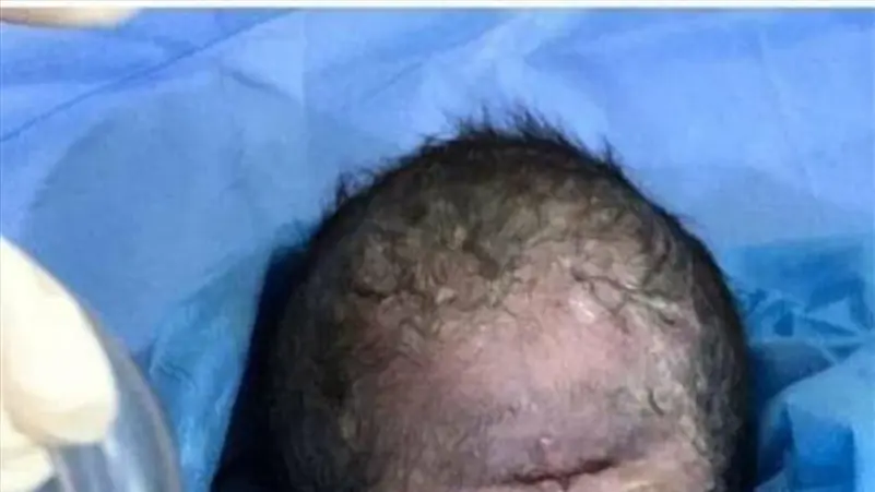 الطب يوضح حالة ولادة غريبة لطفل بعين واحدة في العراق