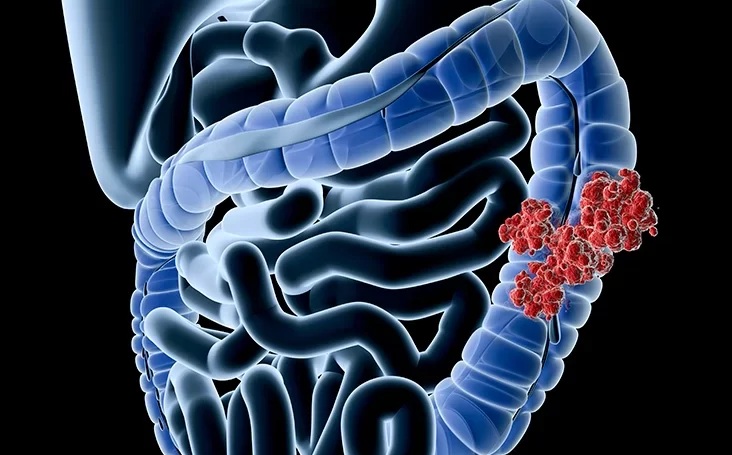 نتائج إيجابية لـ عقار فعال ضد سرطان القولون