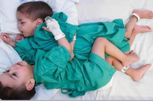 بدء مرحلة التخدير لعملية فصل التوأم السيامي السوري إحسان وبسام