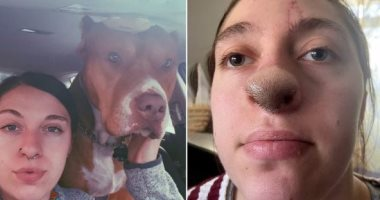 نمو شعر كثيف على أنف أمريكية بسبب عضة كلب