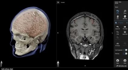 إيلون ماسك يعلن نجاح زراعة الشريحة الدماغية الواعدة