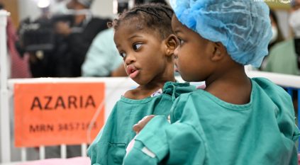 6 مراحل.. بدء عملية فصل التوأم السيامي الجامايكي أزاريا وأزورا