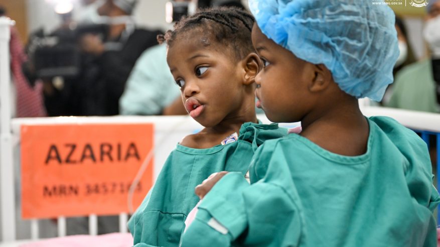 6 مراحل.. بدء عملية فصل التوأم السيامي الجامايكي أزاريا وأزورا