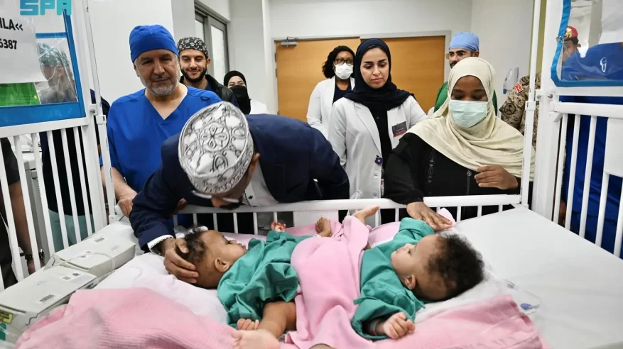 بدء عملية فصل التوأم الملتصق الصومالي رحمة ورملا في الرياض