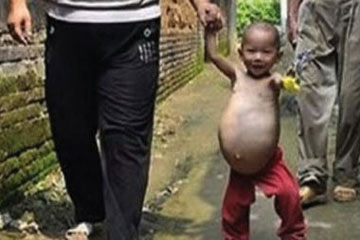 بالصورة.. طفل صينى عمره عامان يحمل أخاه التوأم بمعدته