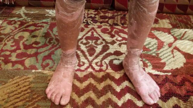 الطفلة”ريم” مصابة الجلد السماكي وعلاجها يكلف شهرياً 2400 ريال
