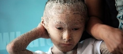 مرض جلدي نادر يحول طفلاً إلى “سمكة”
