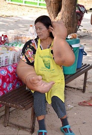 بالصور ..ورم نادر يجعل سيدة تايلندية صاحبة أكبر يدين بالعالم