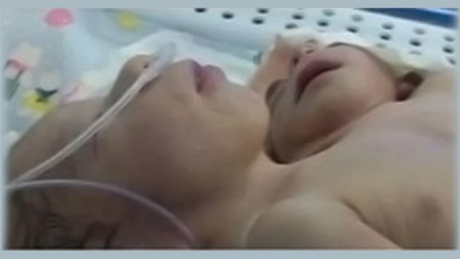 طفل مصري يولد برأسين وقلبين وثلاث أذرع