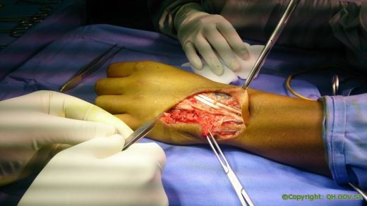 مستشفى النبهانية العام يُعيد الحركة لأصابع مريض أوتاره الباسطة ليد مقطوعة