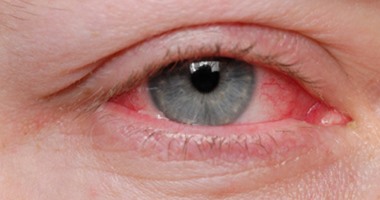 علاج كسل العين