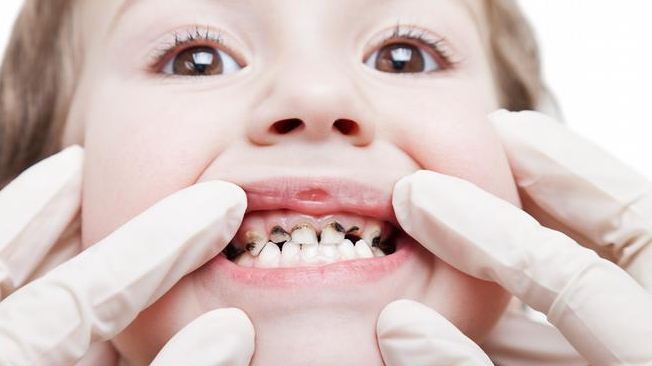 تسوس الأسنان لدى الأطفال بالسعودية يتخطى 90%