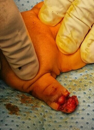 بالصور.. إنقاذ أصابع طفلين من البتر في بلجرشي