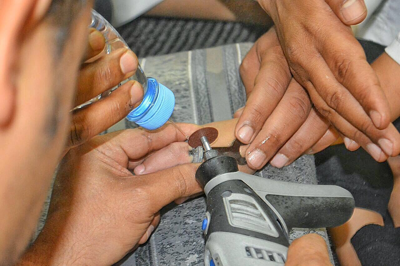 تحرير إصبع طفل عُلِّق بقطعة حديدية في #حائل