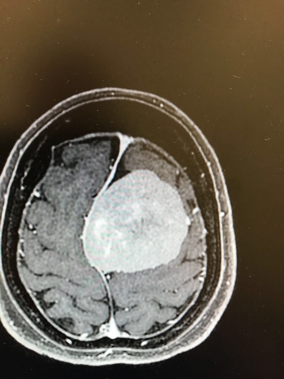 ورم معقّد بالدماغ يصيب مريضة بالشلل وعملية دقيقة تنهي معاناتها